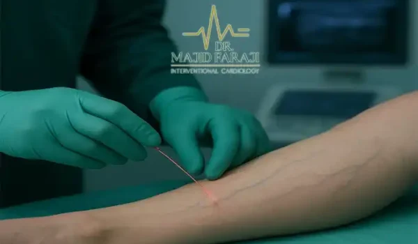 لیزر داخل عروقی