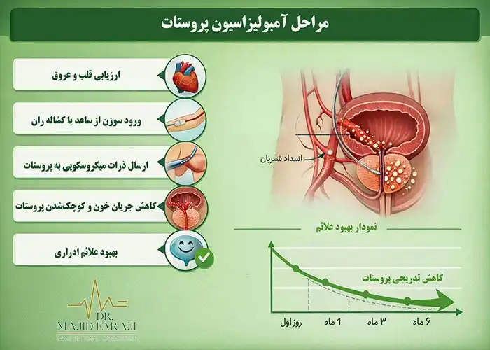 جراحی آمبولیزاسیون پروستات