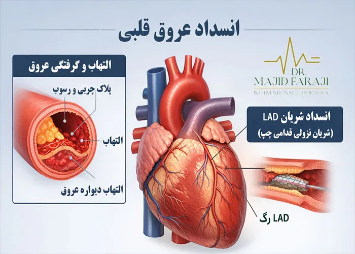 گرفتگی عروق قلبی
