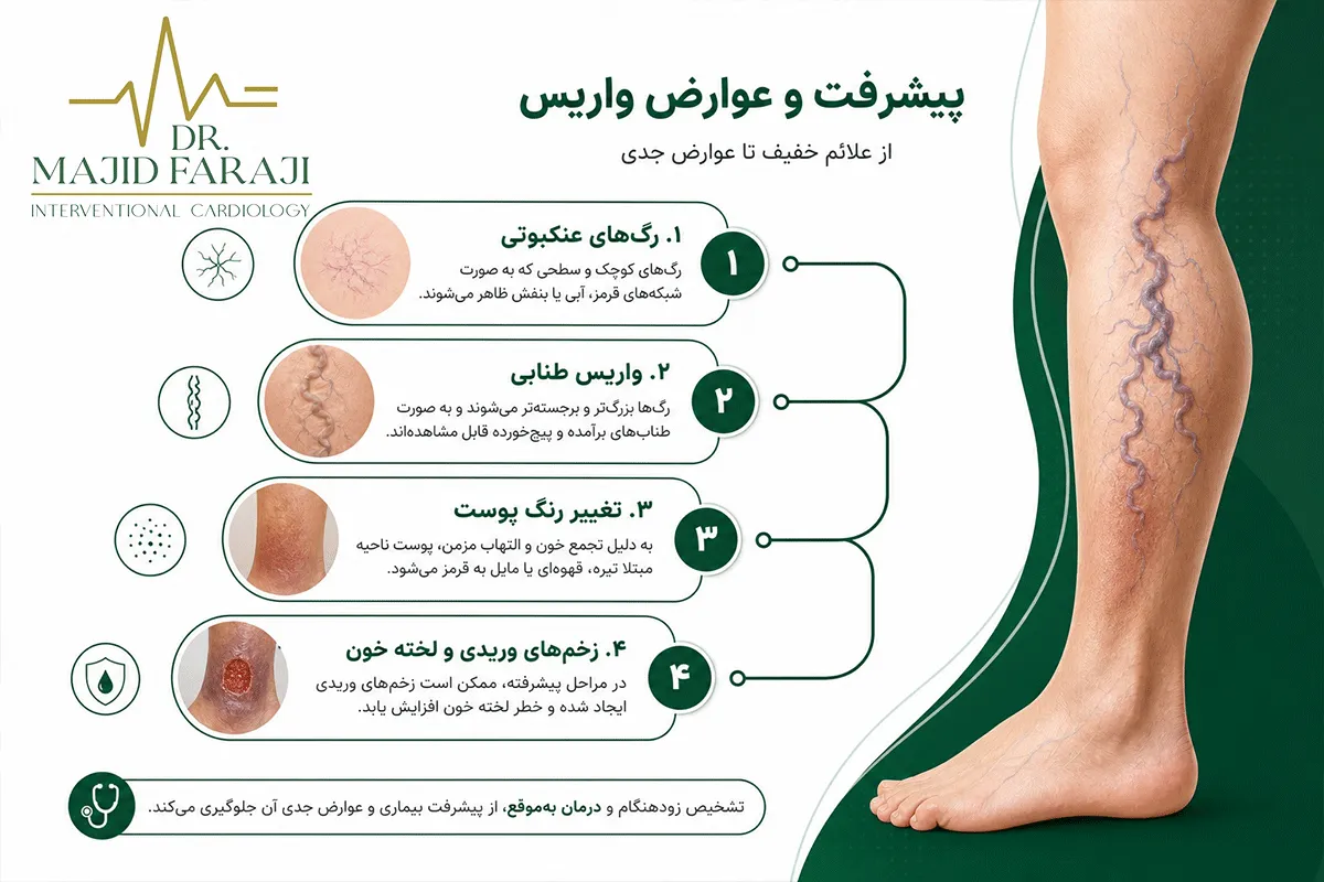 تورم رگ پا