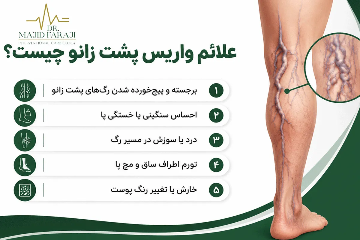 علت واریس پشت زانو