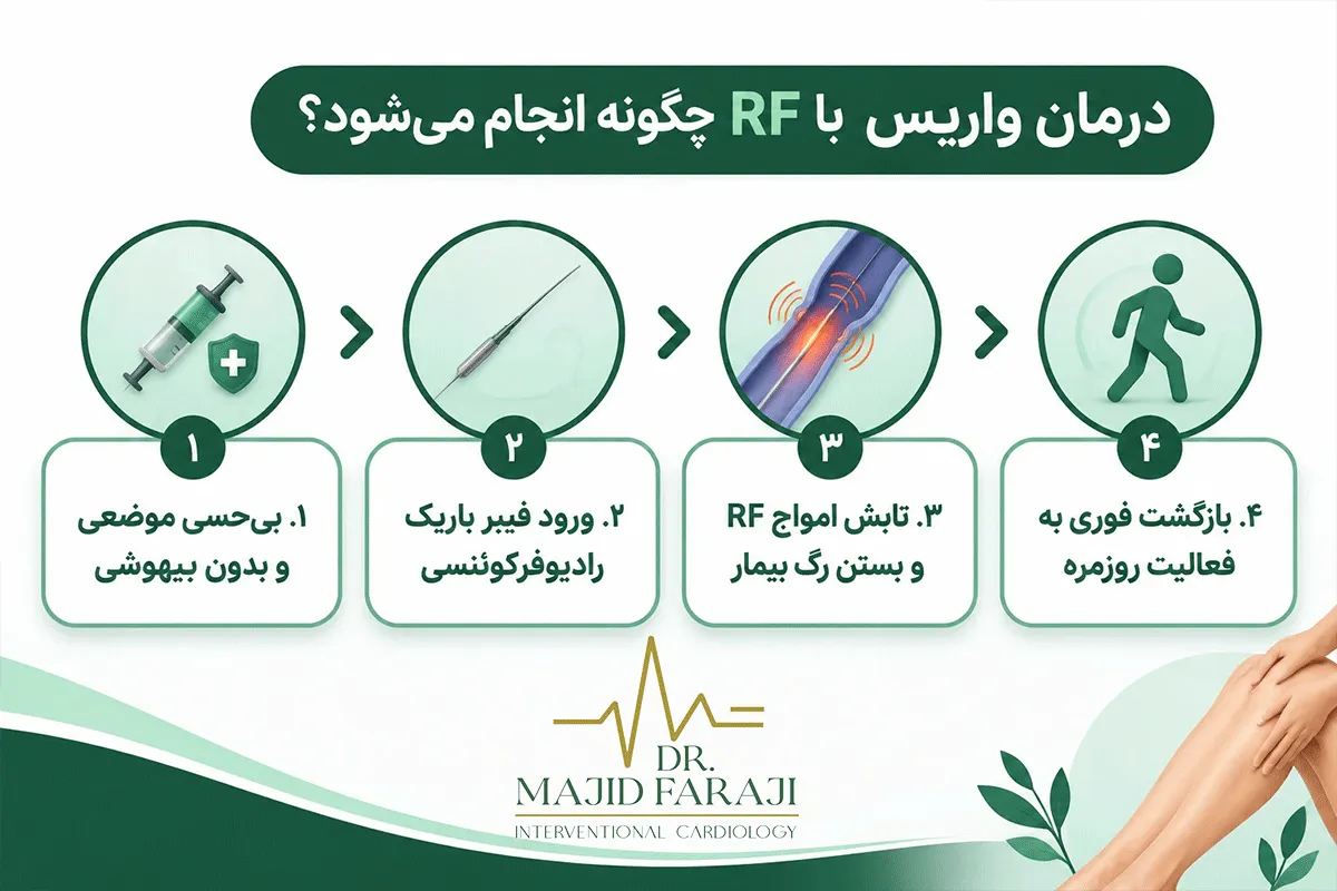 آیا درمان واریس با RF امکان پذیر است؟